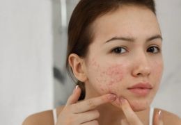 CBD et acné : découverte des bienfaits potentiel sur la peau
