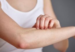 Psoriasis et CBD : comment le cannabidiol peut-il améliorer l'état de votre peau ?